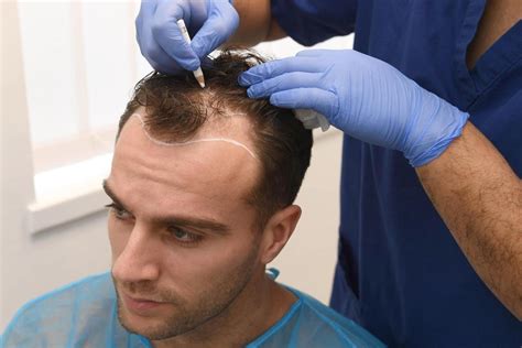 hair transplant turkey best clinic.